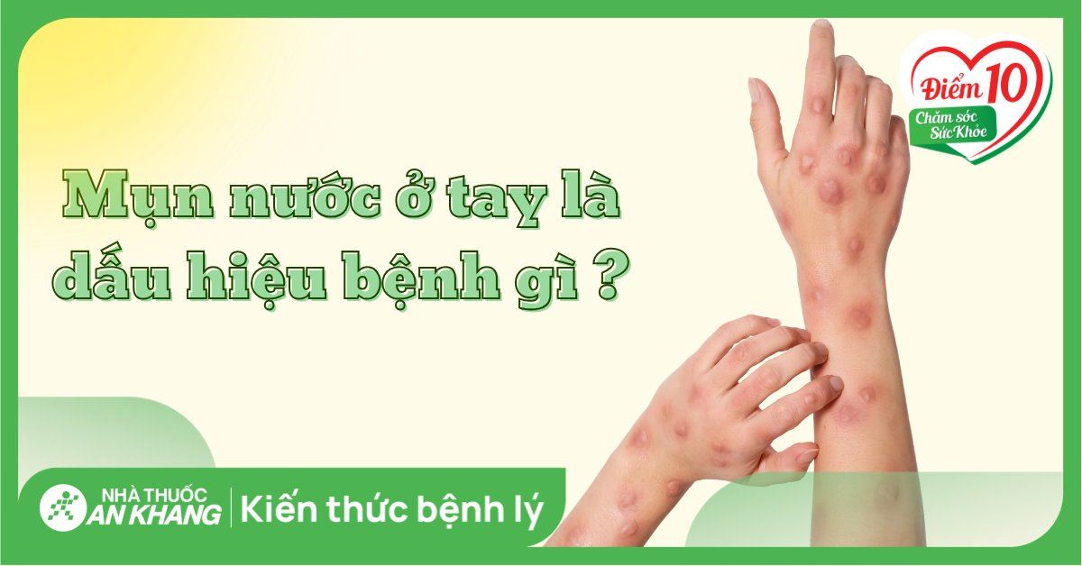 Mụn nước ở tay là dấu hiệu bệnh gì? Cách điều trị hiệu quả
