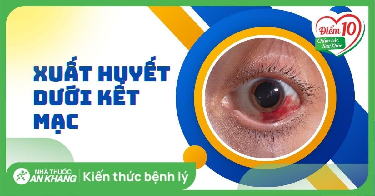 Xuất huyết dưới kết mạc là gì? Nguyên nhân, dấu hiệu và cách điều trị