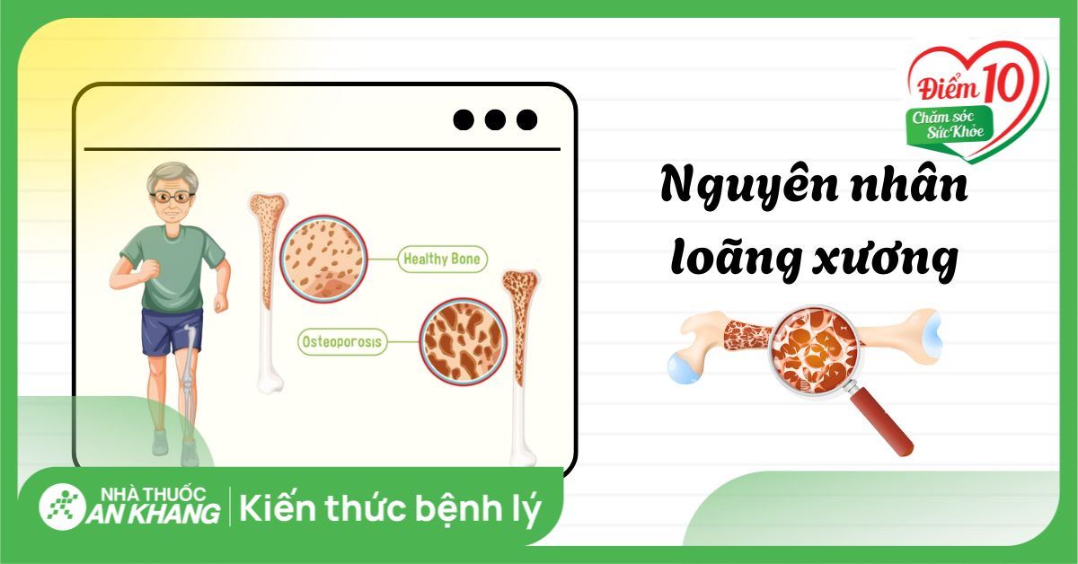 Nguyên nhân loãng xương thường gặp có thể bạn chưa biết