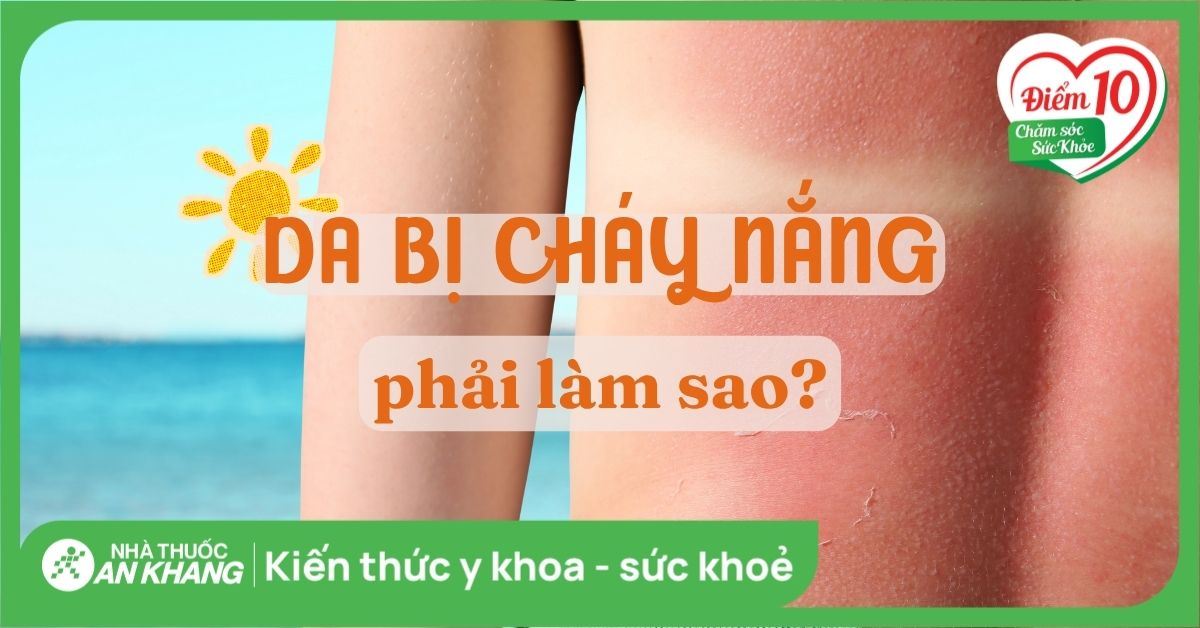 Da bị cháy nắng phải làm sao? Cách điều trị da bị cháy nắng sạm đen