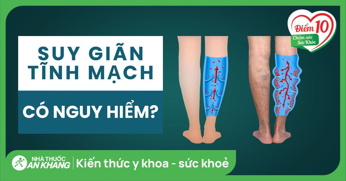 Suy giãn tĩnh mạch có nguy hiểm không?