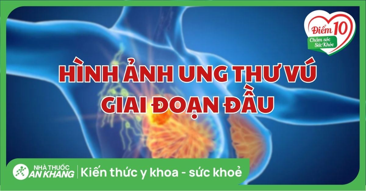 Hình ảnh ung thư vú giai đoạn đầu ở nam và nữ chi tiết nhất