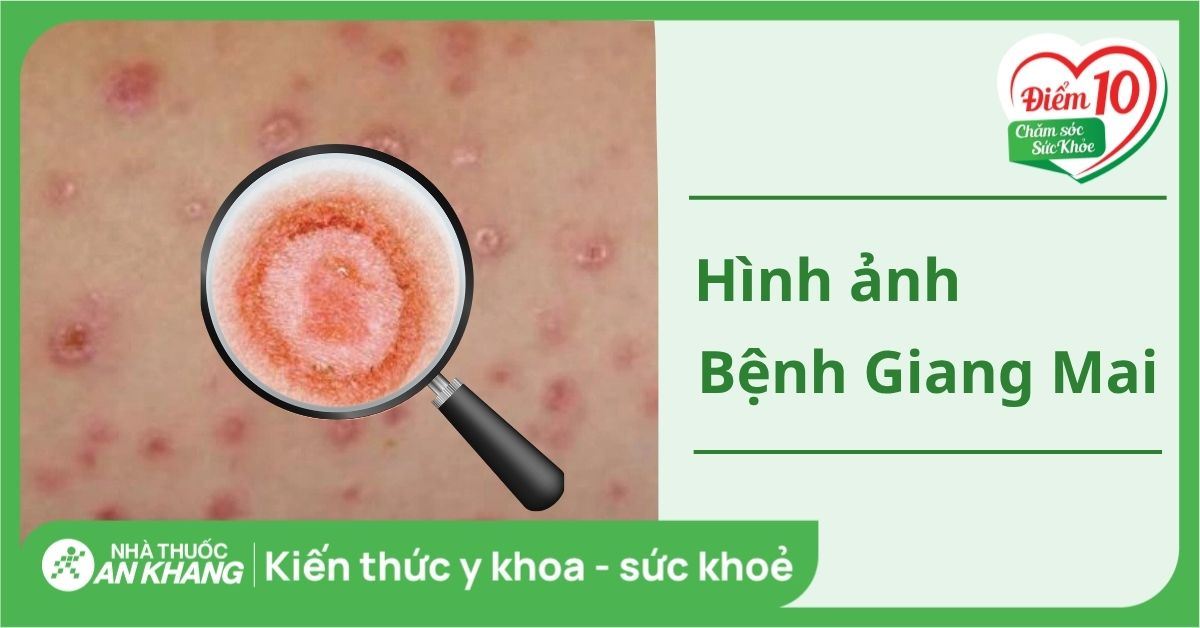 Hình ảnh bệnh giang mai qua từng giai đoạn: Nhận biết sớm để điều trị kịp thời