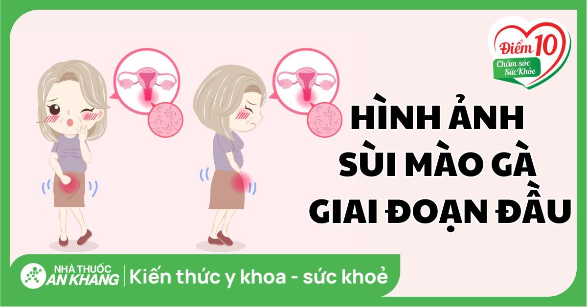 Hình ảnh sùi mào gà giai đoạn đầu ở nam và nữ chi tiết nhất