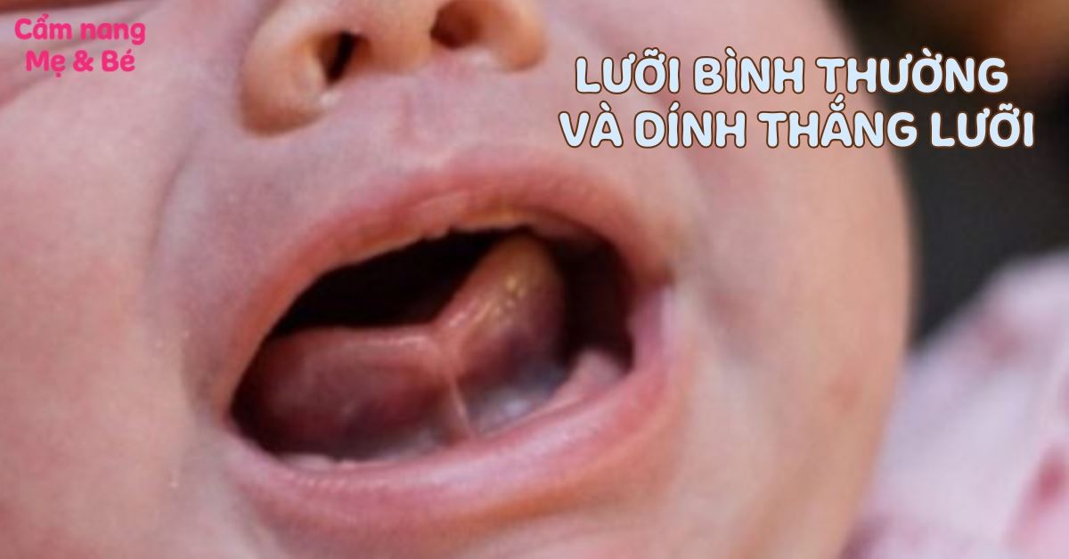 Phân biệt lưỡi bình thường và dính thắng lưỡi ở trẻ và cách chữa 