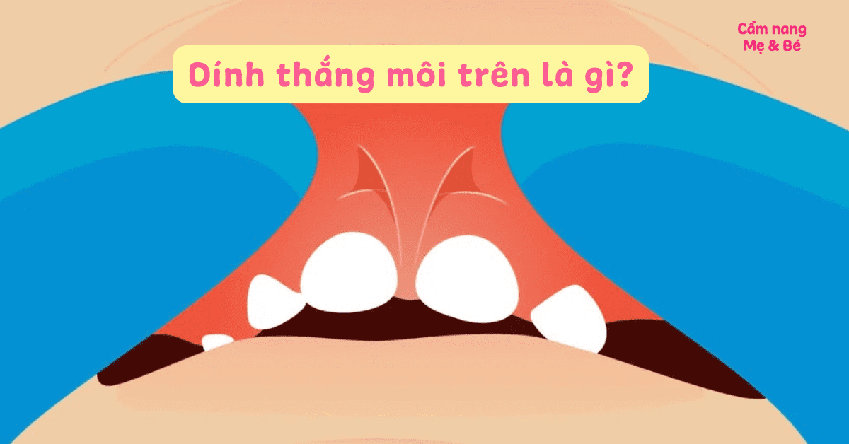 Dính thắng môi trên có tự hết không? Hình ảnh nhận biết và cách điều trị