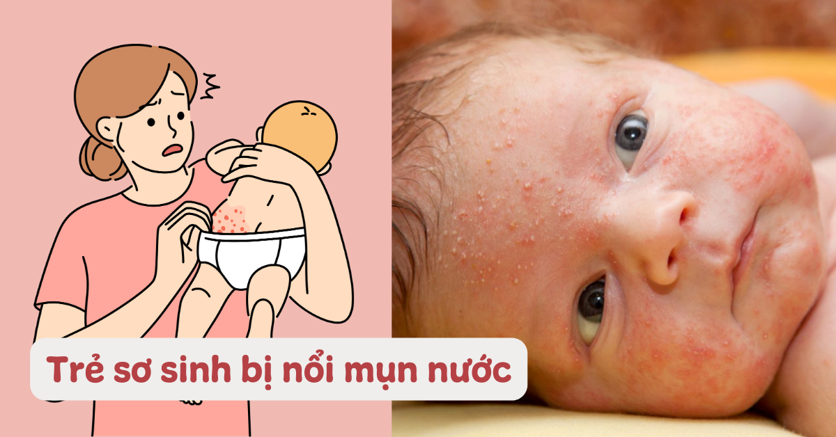 Trẻ sơ sinh nổi mụn nước li ti có phải tình trạng nguy hiểm không? Cách chăm sóc