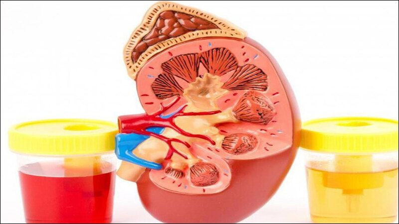 Tiểu ra máu là một trong những dấu hiệu nặng của nhiễm trùng tiểu