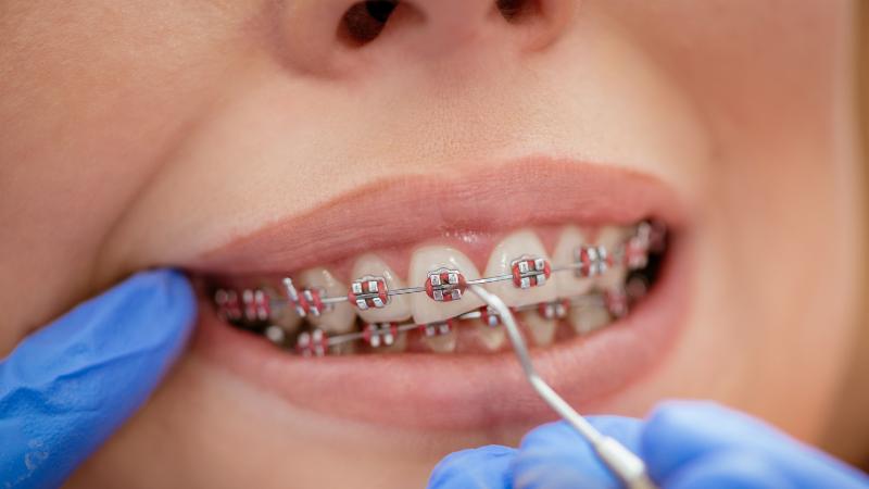 Niềng răng là phương pháp để điều chỉnh vị trí của răng và xương hàm