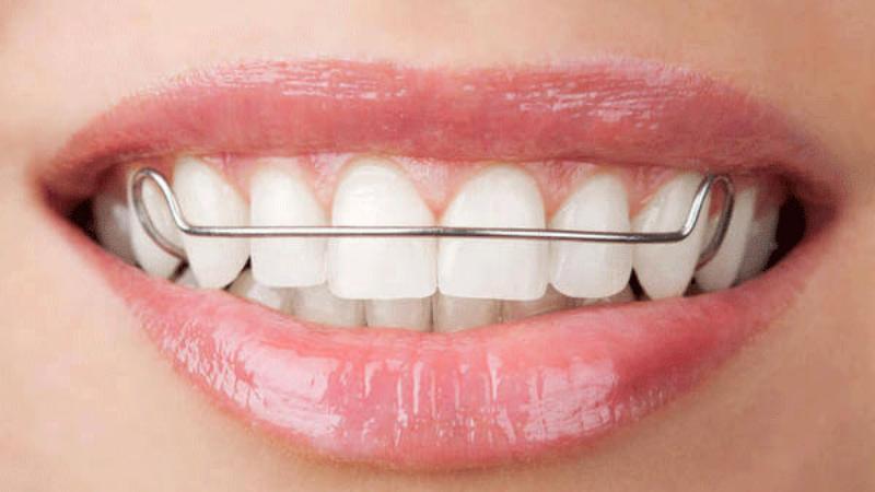 Đeo hàm duy trì thường không gây đau đớn hay khó chịu