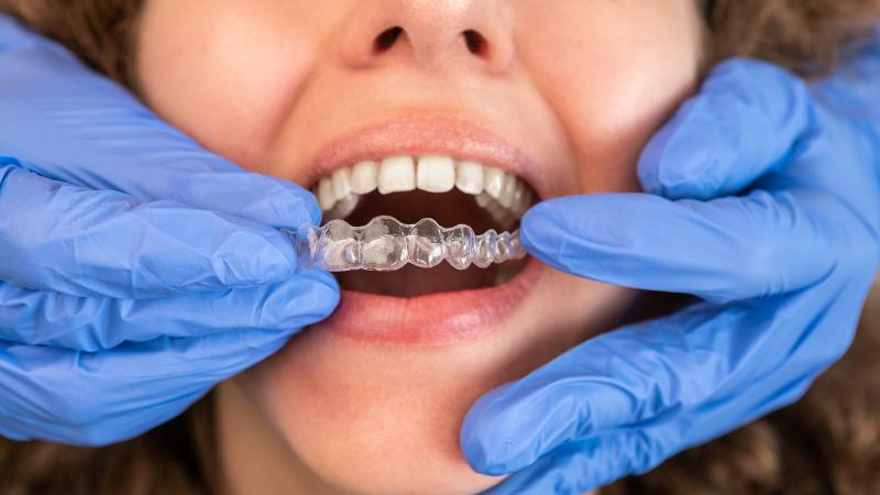 Niềng răng trong suốt là phương pháp thẩm mỹ nhất