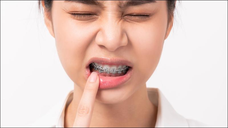 Cảm giác đau khi niềng răng chủ yếu là sự căng tức khi răng di chuyển