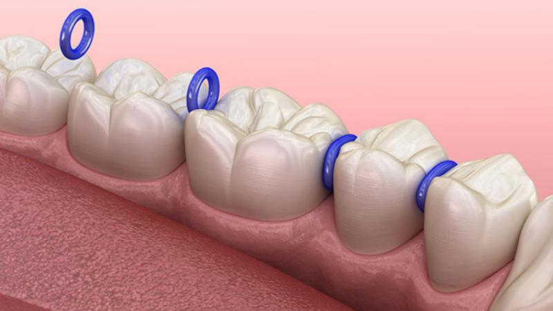 Giai đoạn đặt thun tách kẽ có thể gây khó chịu hoặc đau nhẹ khi ăn nhai