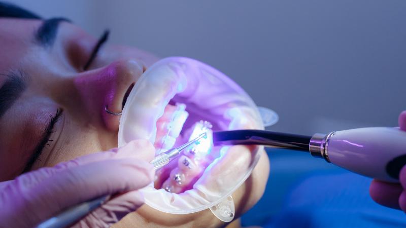 Giai đoạn gắn mắc cài, dây cung gây cảm giác vướng víu, khó chịu trong miệng