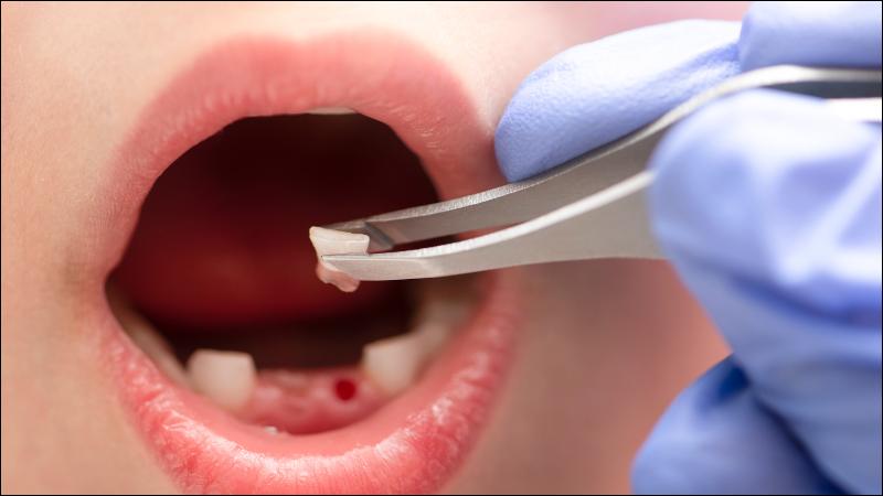 Nhổ răng cho răng di chuyển thường chỉ là sự căng tức và ê buốt nhẹ