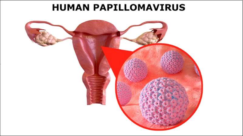 Sùi mào gà ở nữ do virus Human Papillomavirus (HPV) và khó phát hiện