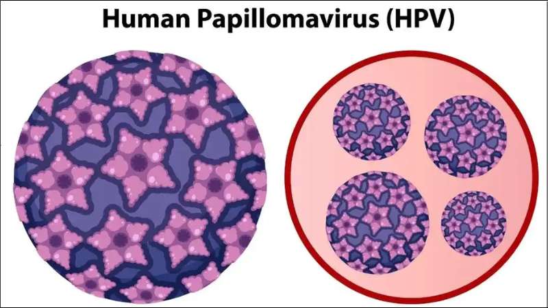 Nguyên nhân gây bệnh sùi mào gà ở nữ phần lớn là do virus Human papilloma (HPV)