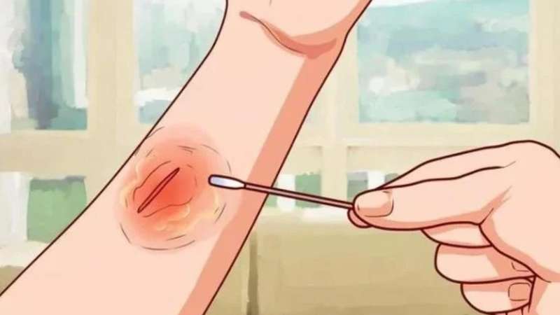 Virus HPV có khả năng lây nhiễm qua đường máu, dịch nhầy,... từ vết thương hở