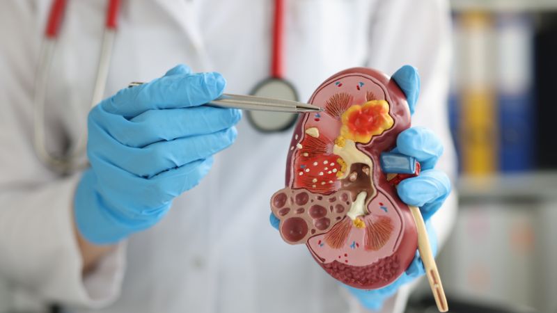 Ăn quá nhiều bột ngọt có thể gây sỏi thận
