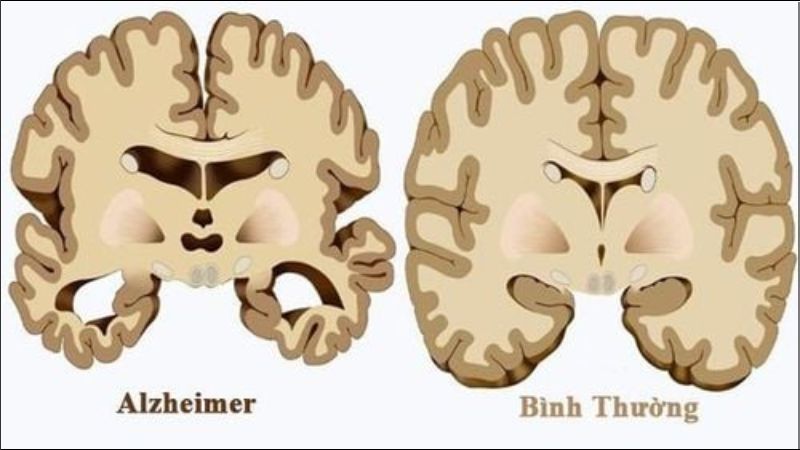 Bệnh Alzheimer là một rối loạn não bộ thường gặp ở người lớn tuổi, gây suy giảm trí nhớ, tư duy và hành vi Bệnh Alzheimer là một rối loạn não bộ thường gặp ở người lớn tuổi, gây suy giảm trí nhớ, tư duy và hành vi