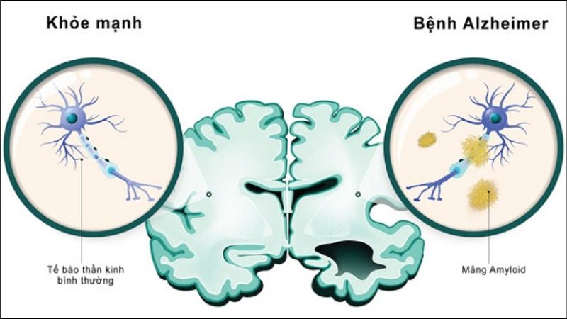 Nguyên nhân của bệnh Alzheimer do sự tích tụ của hai protein amyloid và tau trong não Nguyên nhân của bệnh Alzheimer do sự tích tụ của hai protein amyloid và tau trong não