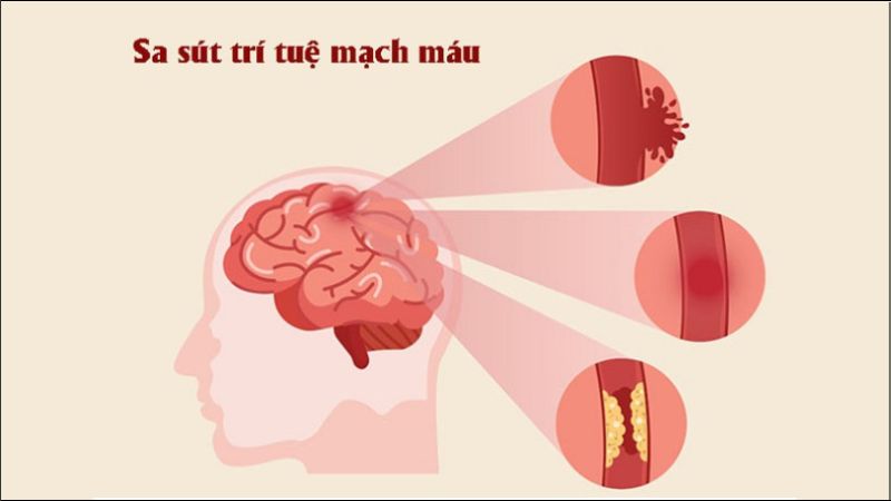 Sa sút trí tuệ mạch máu phổ biến thứ hai, xảy ra do vấn đề về lưu thông máu trong não Sa sút trí tuệ mạch máu phổ biến thứ hai, xảy ra do vấn đề về lưu thông máu trong não