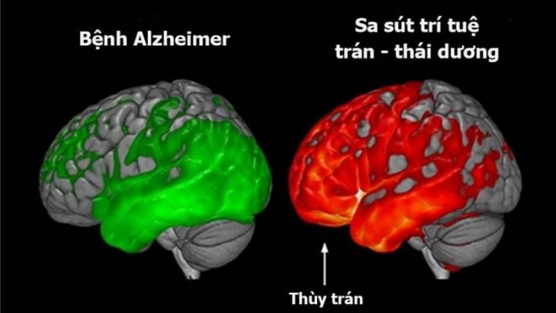 Các vùng não bị ảnh hưởng trong bệnh Alzheimer và sa sút trí tuệ có sự khác biệt rõ rệt Các vùng não bị ảnh hưởng trong bệnh Alzheimer và sa sút trí tuệ có sự khác biệt rõ rệt
