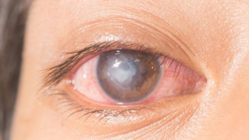Loét giác mạc là một biến chứng nặng của dị vật trong mắt