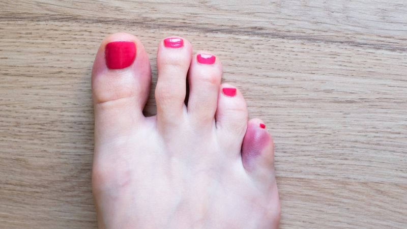 Gãy xương ngón chân là tình trạng xương ngón chân bị nứt hoặc gãy