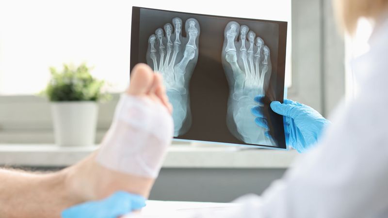 Chụp X-quang sẽ giúp bác sĩ chẩn đoán xác định gãy xương ngón chân