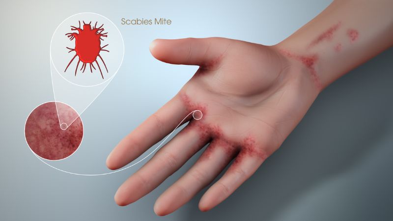 Ghẻ là bệnh ngoài ra do ký sinh trùng Sarcoptes scabiei (bọ ve) gây ra Ghẻ là bệnh ngoài ra do ký sinh trùng Sarcoptes scabiei (bọ ve) gây ra