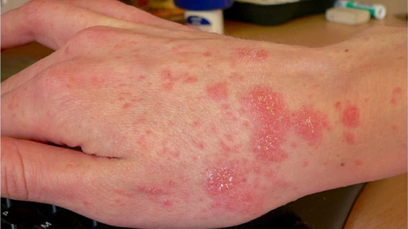 Nổi vết ban đỏ trên da có thể là triệu chứng của bệnh ghẻ Nổi vết ban đỏ trên da có thể là triệu chứng của bệnh ghẻ