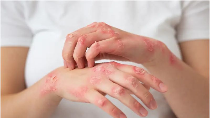 Ngứa da dữ dội là dấu hiệu cần đến khám bác sĩ sớm Ngứa da dữ dội là dấu hiệu cần đến khám bác sĩ sớm