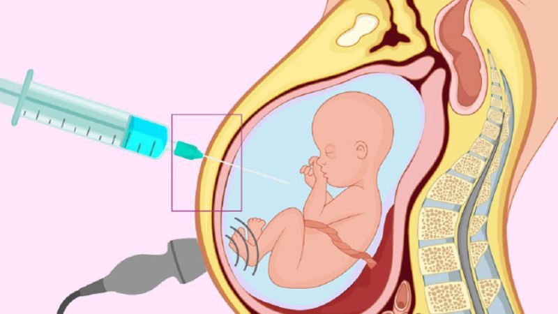 Chọc ối có thể giúp chẩn đoán hội chứng Fragile X từ sớm Chọc ối có thể giúp chẩn đoán hội chứng Fragile X từ sớm