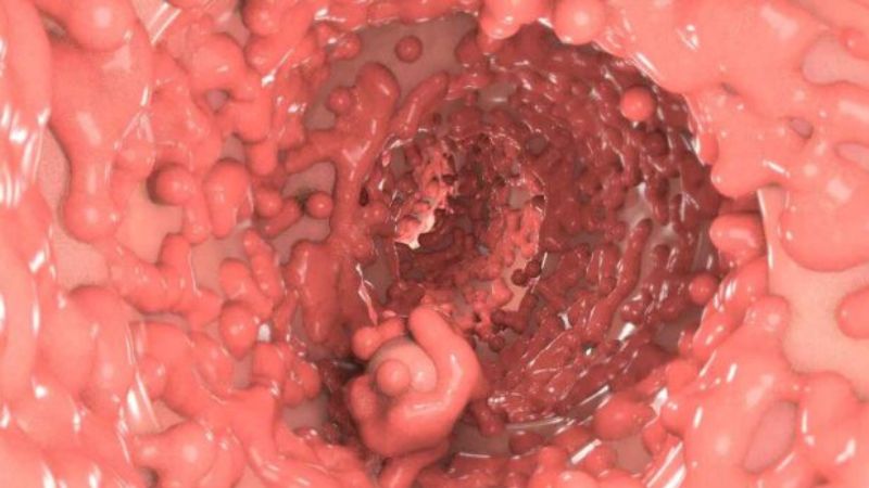 Đa polyp di truyền là một nguyên nhân gây bệnh Đa polyp di truyền là một nguyên nhân gây bệnh