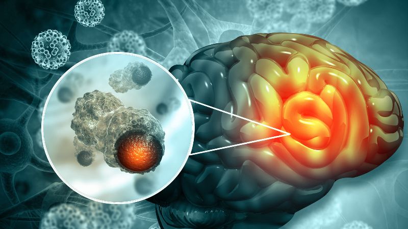 U não là một trong những nguyên nhân gây sa sút trí tuệ đảo ngược U não là một trong những nguyên nhân gây sa sút trí tuệ đảo ngược