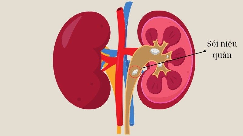 Sỏi thận có thể gây biến chứng sỏi niệu quản gây ứ đọng nước tiểu