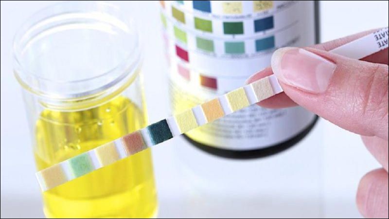 Đo pH nước tiểu có thể giúp chẩn đoán biến chứng của sỏi thận