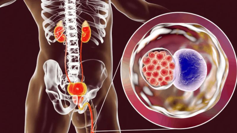 Bệnh Chlamydia là bệnh STD phổ biến do vi khuẩn Chlamydia trachomatis gây nên Bệnh Chlamydia là bệnh STD phổ biến do vi khuẩn Chlamydia trachomatis gây nên