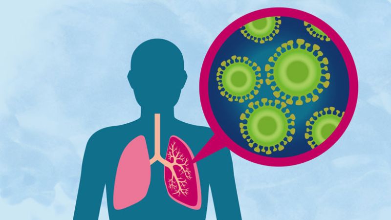 Viêm phổi bội nhiễm là bệnh lý thường gặp ở người bệnh HIV/AIDS giai đoạn 4 Viêm phổi bội nhiễm là bệnh lý thường gặp ở người bệnh HIV/AIDS giai đoạn 4