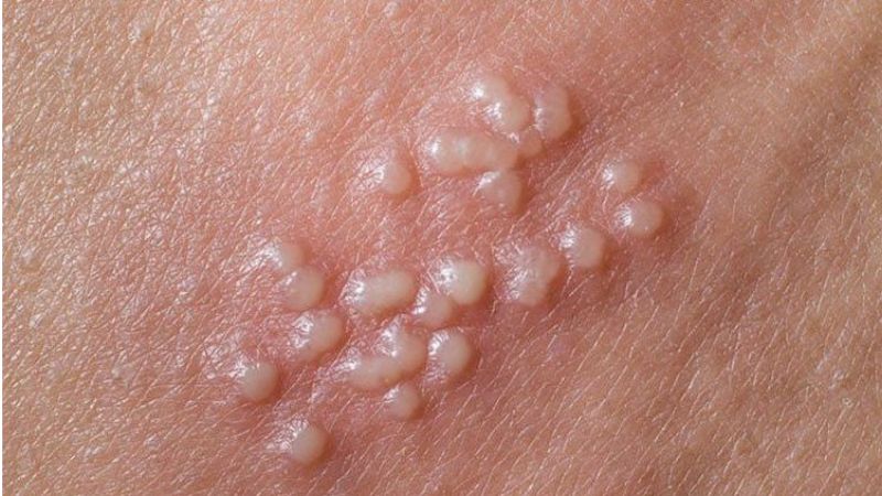 Các mụn nước mọc thành chùm là dấu hiệu điển hình của bệnh Herpes sinh dục Các mụn nước mọc thành chùm là dấu hiệu điển hình của bệnh Herpes sinh dục