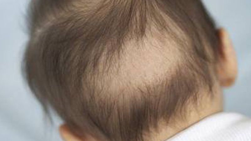 Trẻ nhỏ bị thiếu canxi thường bị rụng tóc Trẻ nhỏ bị thiếu canxi thường bị rụng tóc