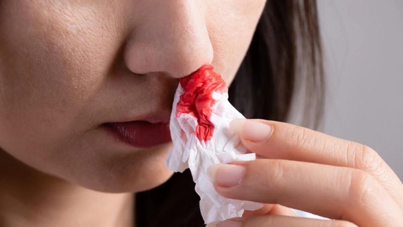 Chảy máu mũi là triệu chứng có thể gặp ở bệnh nhân thủng vách ngăn mũi