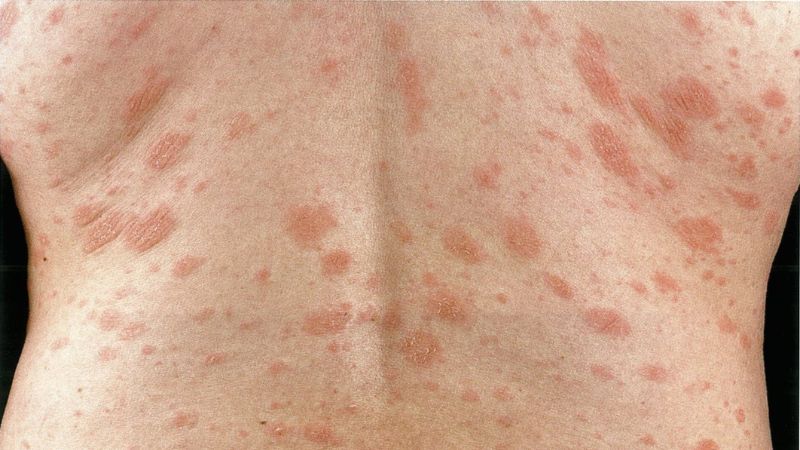 Tổn thương vảy phấn hồng thường có hình tròn hoặc bầu dục