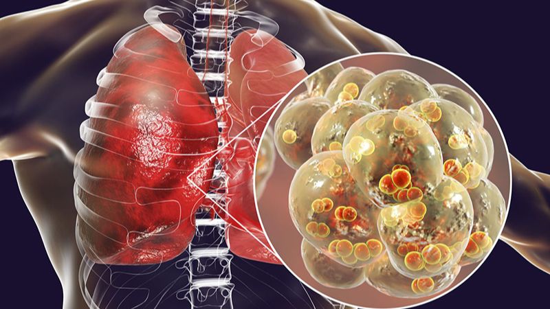 Viêm não Nhật Bản điều trị kéo dài có thể dẫn đến viêm phổi