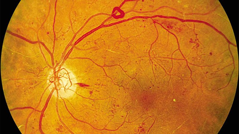 Bệnh xảy ra do các vi mạch máu tại võng mạc bị tổn thương bởi đường huyết cao kéo dài Bệnh xảy ra do các vi mạch máu tại võng mạc bị tổn thương bởi đường huyết cao kéo dài