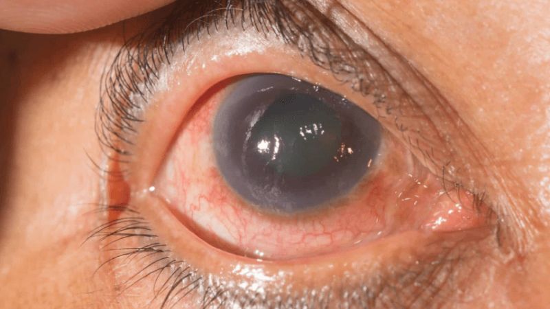 Người mắc bệnh võng mạc do đái tháo đường có thể bị tăng nhãn áp Người mắc bệnh võng mạc do đái tháo đường có thể bị tăng nhãn áp