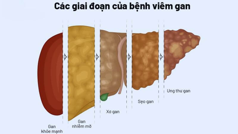 Bìm bìm hỗ trợ điều trị gan nhiễm mỡ, viêm gan, xơ gan