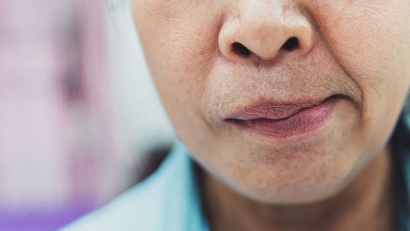 Liệt một bên mặt đột ngột có thể là biểu hiện của cơn thiếu máu não thoáng qua