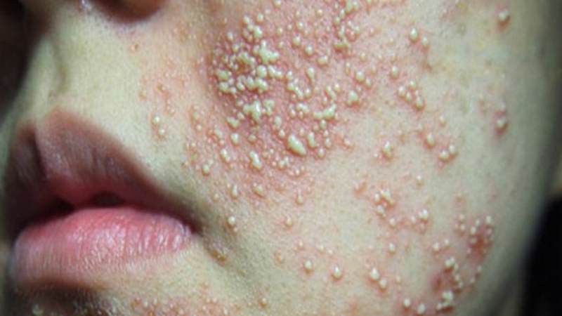 Da nhiễm corticoid là tình trạng viêm da do lạm dụng sản phẩm chứa corticoid